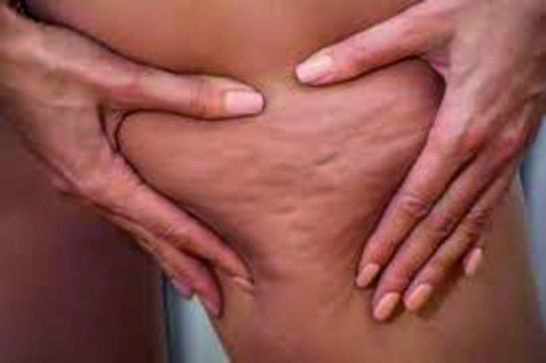 Trattamento anti-cellulite con calchi a Castiglione Torinese - Estetica Margherita